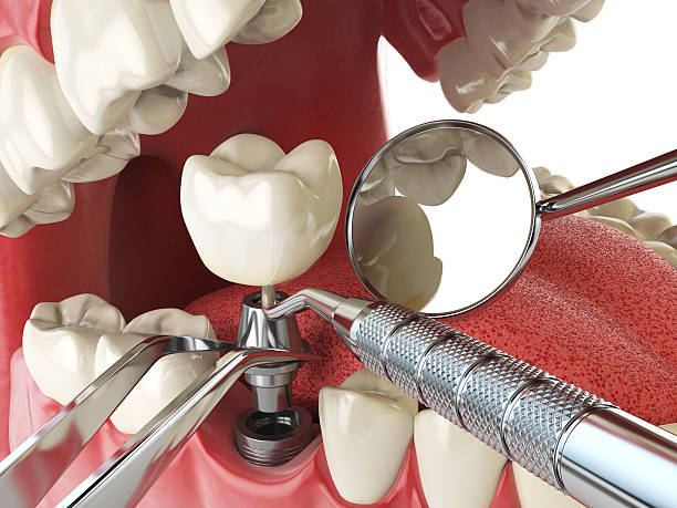 Best Emergency Tooth Extraction in Medina, NY